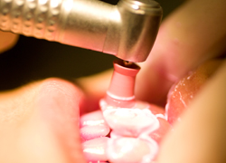むし歯と歯周病予防に有効なPMTC